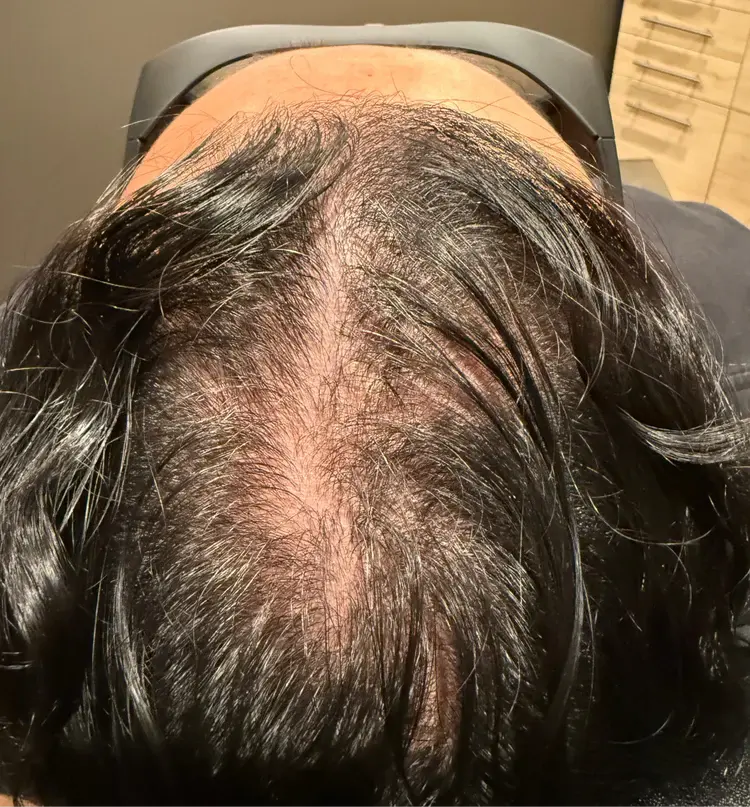 Joe before Folix treatment