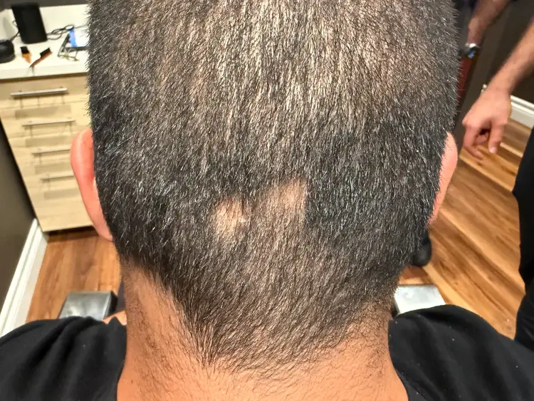 Roman before Folix treatment