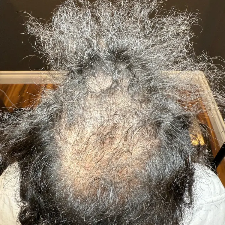 Vik T. before Folix treatment