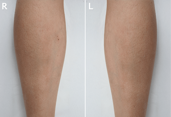 Torso after Splendor X laser hair removal