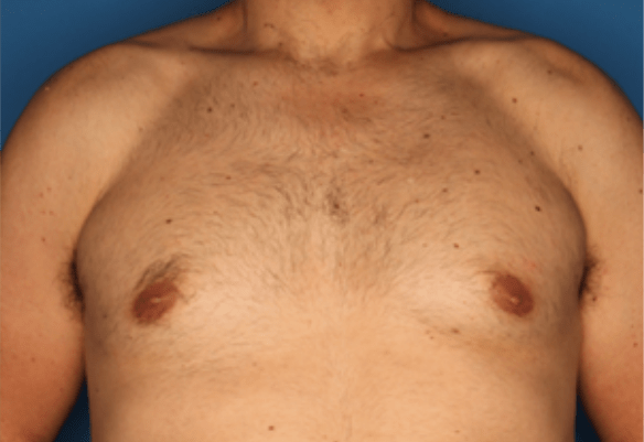 Chest area after Splendor X laser hair removal