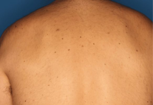 Underarm after Splendor X laser hair removal