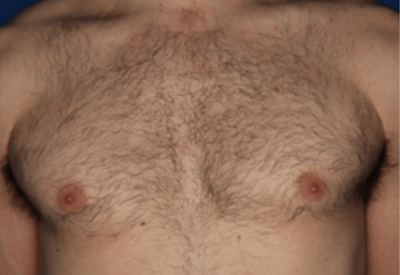 Chest after Splendor X laser hair removal