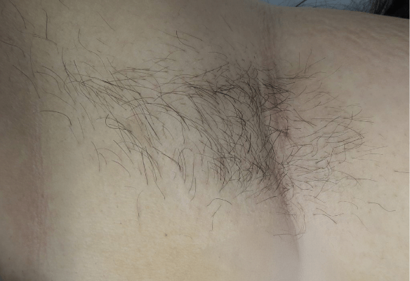 Underarm before laser hair removal