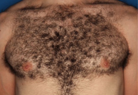 Chest before laser hair removal