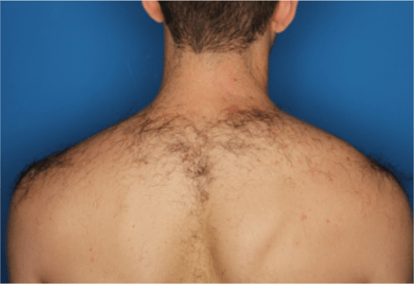 Back before laser hair removal